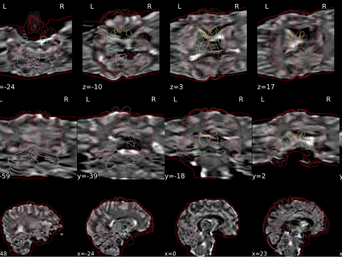 Bad EPI spatial normalization