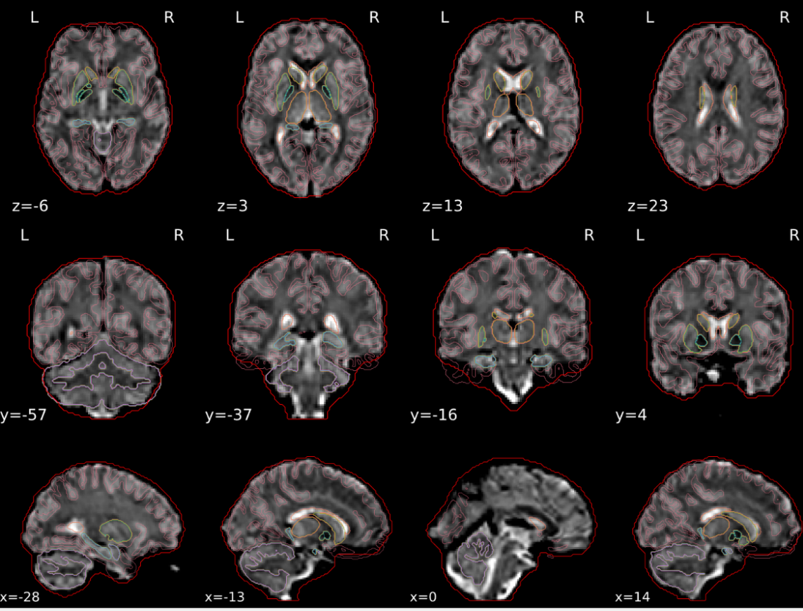 Good EPI spatial normalization