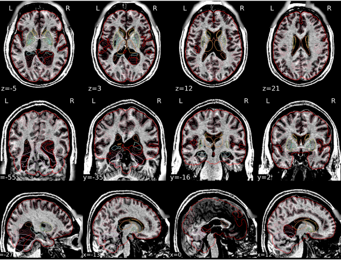 Bad T1w spatial normalization