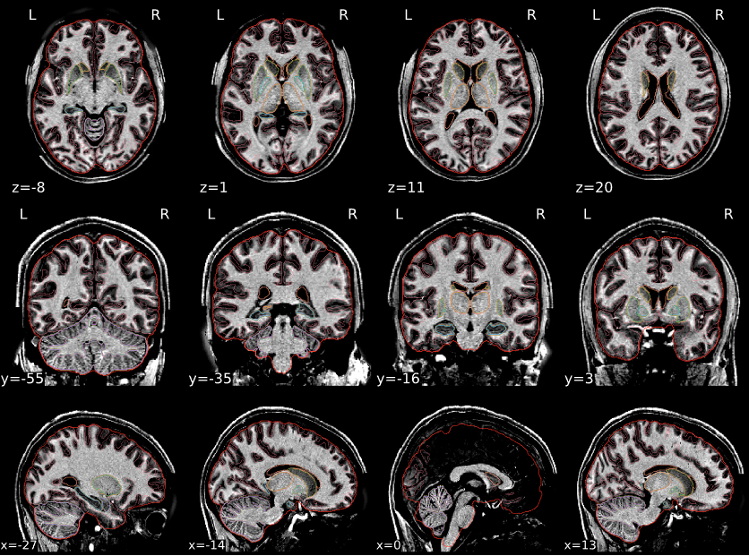 Good T1w spatial normalization