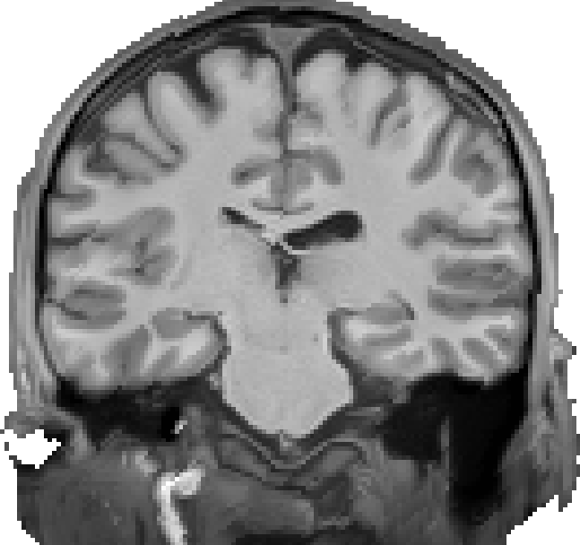 Axial slice of a T1w image
